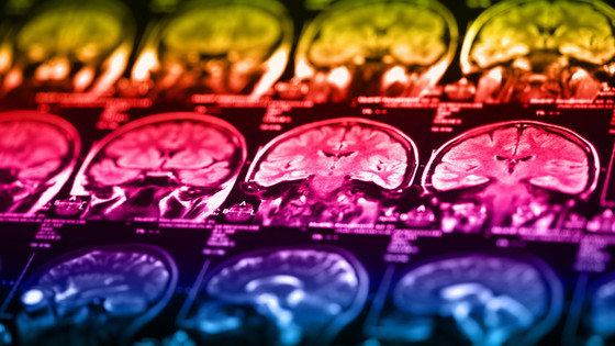 Et nyt forskningsresultat viser, at næsten alle patienter med posterior cortikal atrofi har underliggende Alzheimers sygdom, selvom symptombilledet ser noget anderledes ud